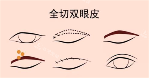 全切双眼皮经过 全切双眼皮经过