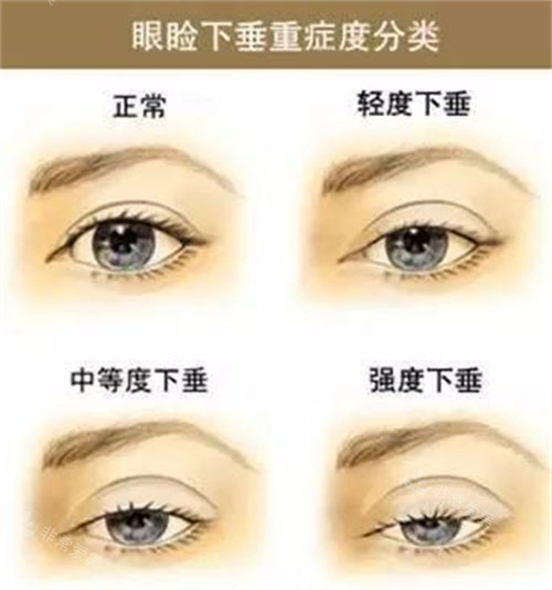 眼睑下垂程度 眼睑下垂程度