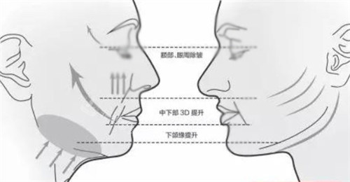 面部提升前后各个部位的对比 面部提升前后各个部位的对比