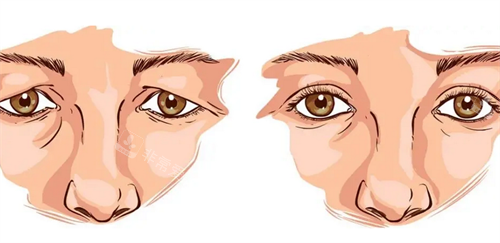 雙眼皮修復(fù)前后