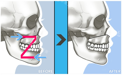 双鄂手术的过程及对比 双鄂手术的过程及对比