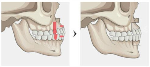 双颚手术 双颚手术