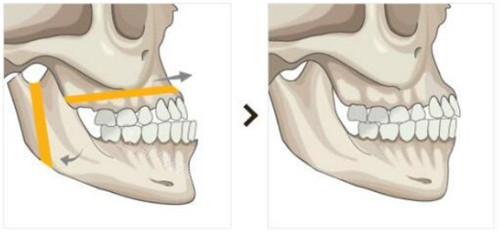 双鄂手术前后对比 双鄂手术前后对比