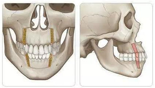 双鄂手术方式前方和侧方演示动画图 双鄂手术方式前方和侧方演示动画图