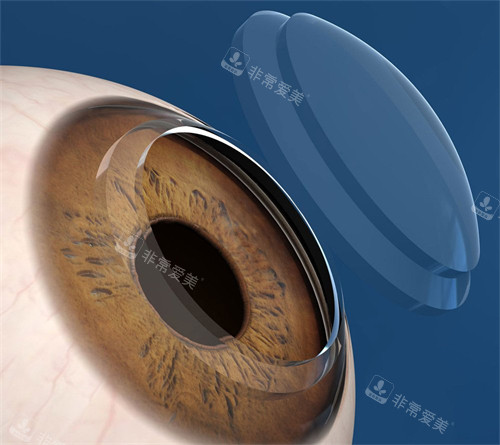 角膜移植手术动画图