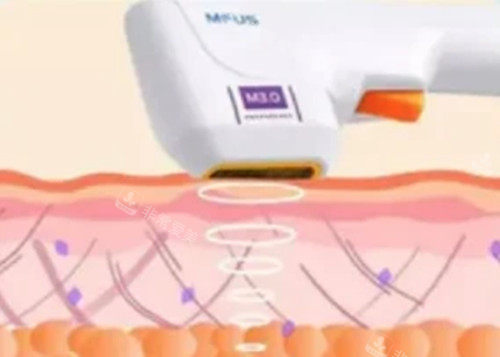 超声炮面部美容卡通示意图 超声炮面部美容卡通示意图