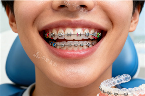 儿童牙齿矫正图片