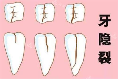 牙齿裂纹的程度