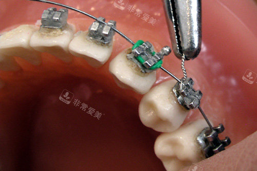 牙齿矫正器安装示意图