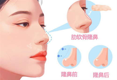 超肋骨隆鼻整形手术卡通图