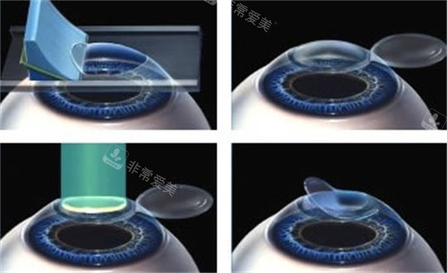 准分子激光手术过程