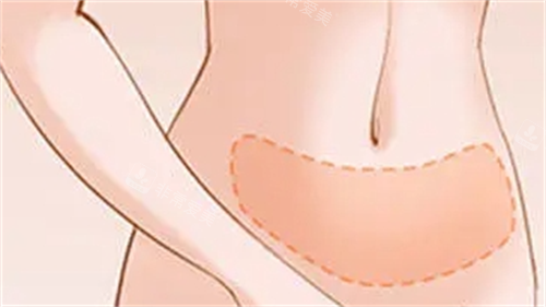 腹部吸脂成效展示图