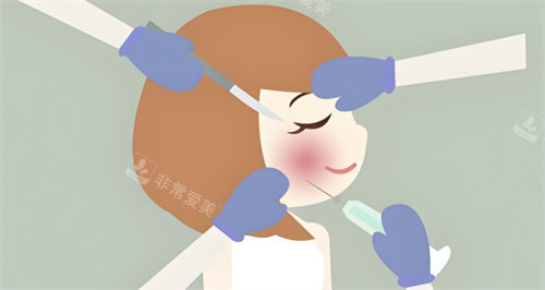 玻尿酸注射图 玻尿酸注射图