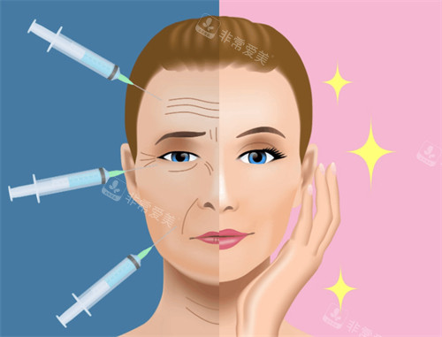 注射去皱前后对比 注射去皱前后对比