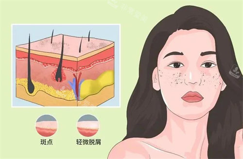 祛斑卡通动画图 祛斑卡通动画图