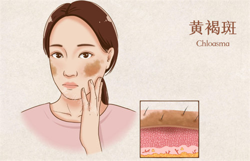 祛斑卡通图片展示 祛斑卡通图片展示