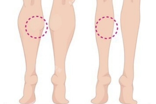 小腿肌肉消除对比图