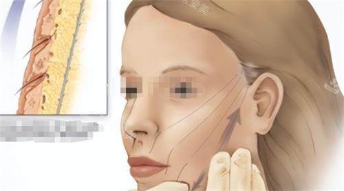 面部青春肽支架提升示意图