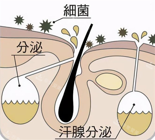 腋臭是怎么形成的