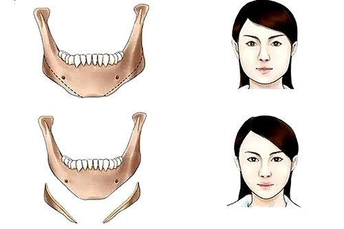 下頜角整形卡通對比圖