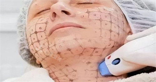 本地人私藏！韩国热玛吉技术正规的医院排名榜，技术优势一目了然