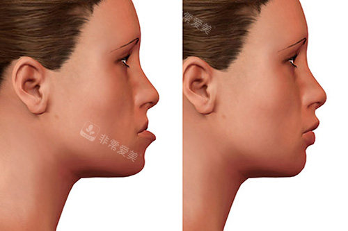 牙齿矫正对比图