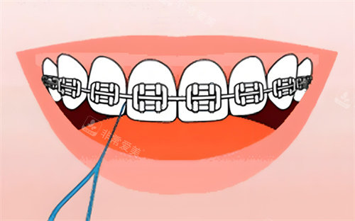 金属牙齿矫正卡通图片