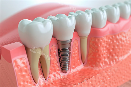 种植牙与正常牙齿模型对比漫画图