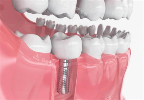 种植牙模型展示图片