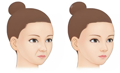 祛法令纹前后对比