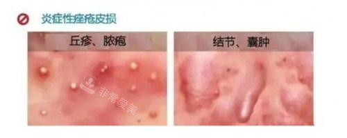 炎症性痤疮照片
