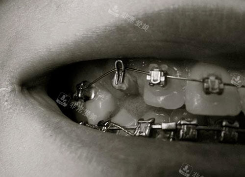 牙齿矫正牙套金属托槽牙套