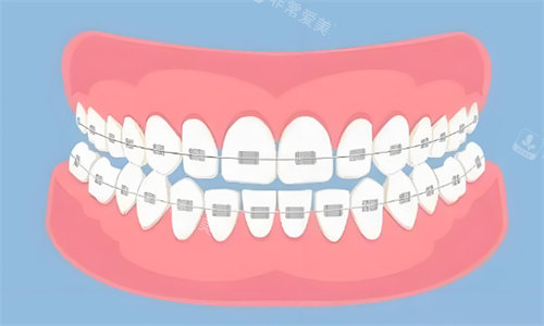 金属矫正牙齿