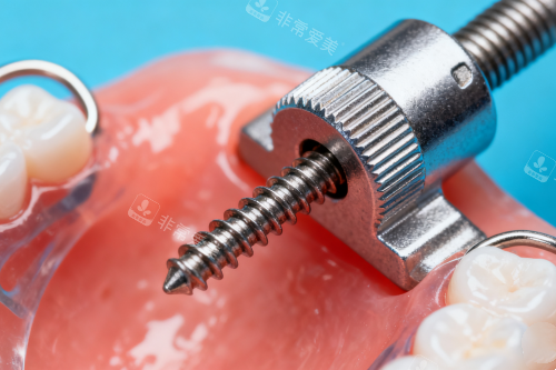 牙齿保持器安装图片展示