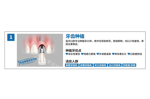 蓝天口腔种植牙优势图