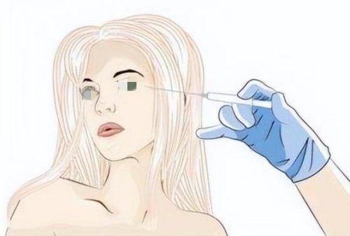 注射胶原蛋白去泪沟示意图