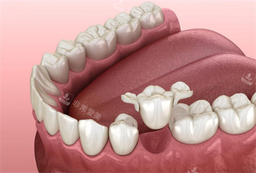 牙齿修复动画展示图