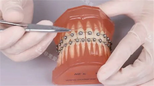 球面自锁托槽矫正怎么做的