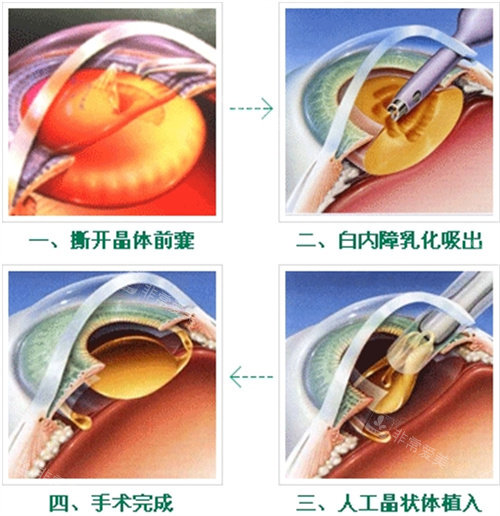 白内障手术过程图