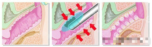 菲蜜丽过程卡通图
