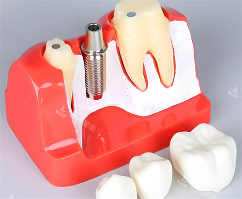 牙齿模型种植体