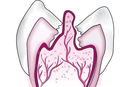 牙齿内息肉侧面图