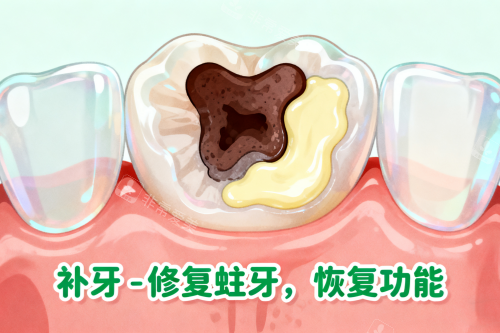 牙齿蛀牙修复展示图