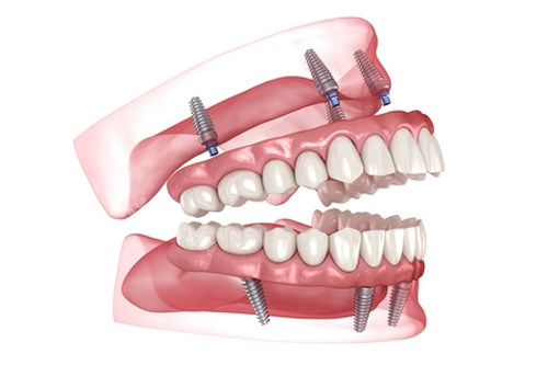 all-on-4全口种植牙模型图