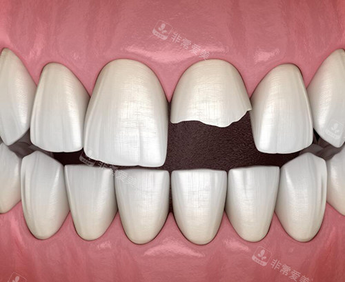 牙齿缺损图