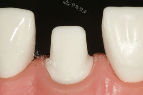 打磨牙齿示意图