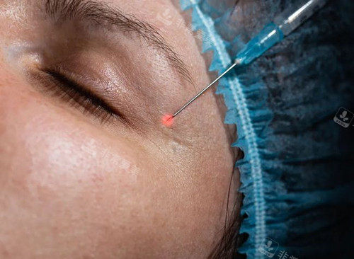 眼周玻尿酸注射