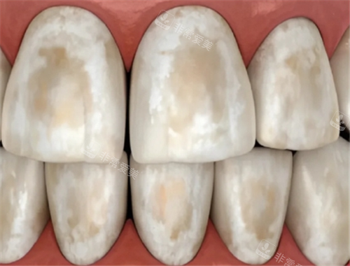 牙齿脱矿照片