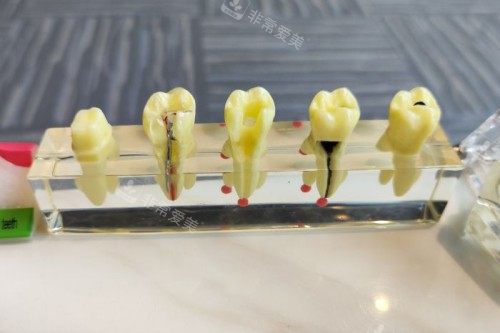 烟台刘芳口腔牙齿模型