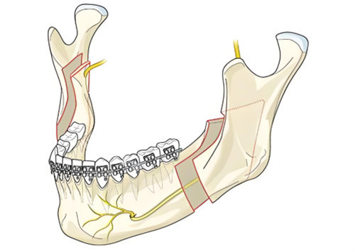 广州磨下颌角哪家整形医院技术好呢？网友票选前三名医院你都知道吗？